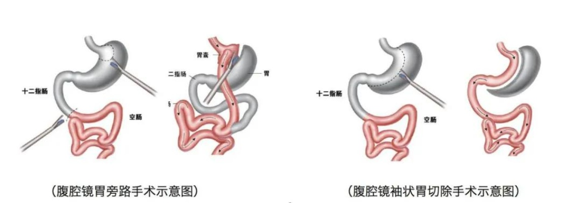 胃不舒服要动刀？盘点5种常见胃部小手术